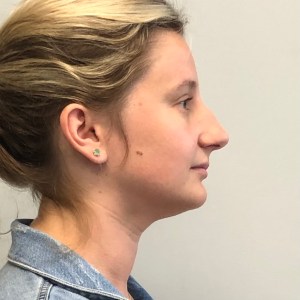Young woman nose job with bone and nasal tip custom Rhinoplasty pre operative side view – pre op lateral blonde